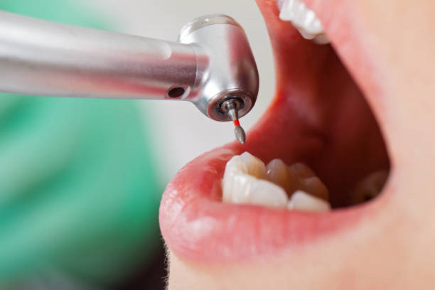 Best Emergency Dental Care for Broken or Chipped Teeth in Euclid, OH